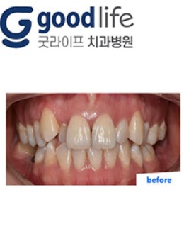 韩国goodlife牙齿矫正正畸对比图