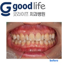 韩国goodlife牙齿美白贴面对比图