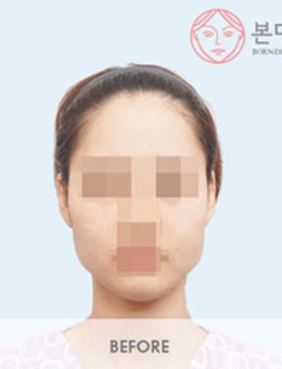 韩国BornDi整形做下颌角手术真人案例分享