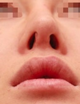 韩国美line整形歪鼻矫正案例