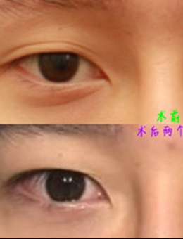 -韩国美line整形非切开眼提肌+后眼角手术前后对比图