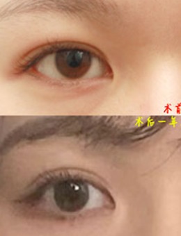 韩国美line整形非切开眼提肌+去眼皮脂肪+眼尾手术_术前