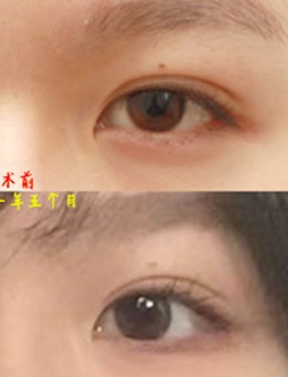 韩国美line整形非切开眼提肌+去眼皮脂肪+眼尾手术_术后