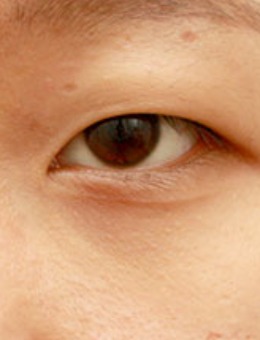 -韩国美line整形眼提及+前后眼角手术对比图