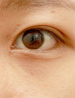 -韩国美line整形眼提及+前后眼角手术对比图
