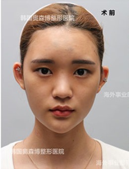 -韩国德丽珍整形双眼皮修复+眼提肌+鼻整形案例