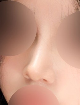 韩国Yellow整形外科隆鼻前后对比照