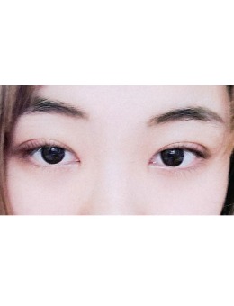 -韩国yellow双眼皮手术前后对比图
