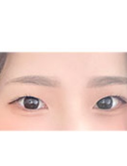 -韩国yellow整形外科双眼皮对比案例