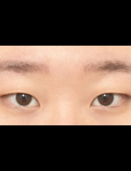 -韩国icon整形医院双眼皮+开眼角对比图