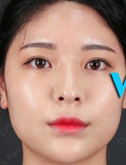 -韩国TS整形隆鼻+轮廓手术高清案例打包分享！