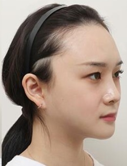 韩国note轮廓整形+双下巴吸脂手术对比照片