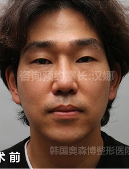 韩国奥森博男士轮廓+下颌角环节手术对比图