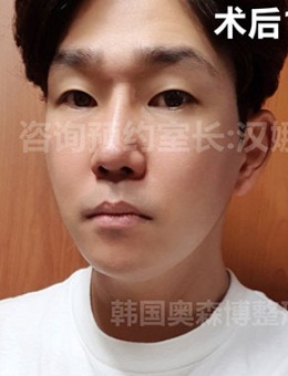 韩国奥森博男士轮廓+下颌角环节手术对比图_术后