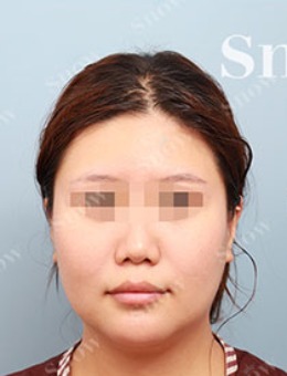 韩国snow颧骨手术+双下巴吸脂前后对比图