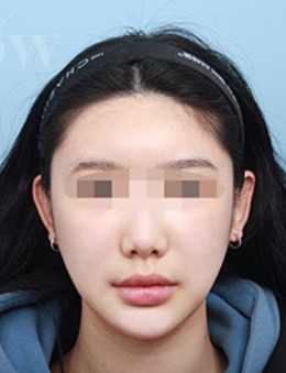 -韩国snow整形面部吸脂手术前后对比案例分享！