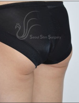 首尔slim外科的提臀塑臀手术