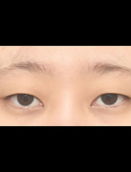 -韩国icon非切开眼型矫正+外眼角手术前后对比照