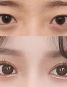 -韩国icon眼部埋线修复手术前后对比图