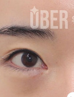 韩国玉芭整形双眼皮+提肌修复+下眼睑手术对比图