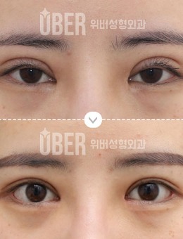 -韩国玉芭修复“双眼皮肉条”前后对比照片