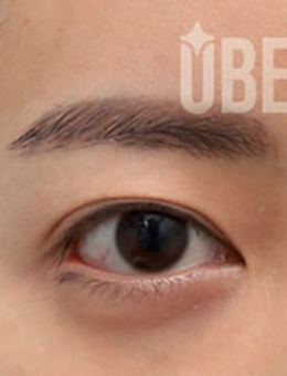 韩国玉芭整形眼提肌修复前后对比图