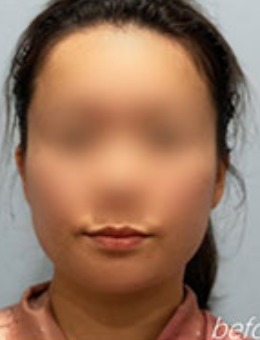 韩国dr朵整形面部吸脂手术前后对比图_术前