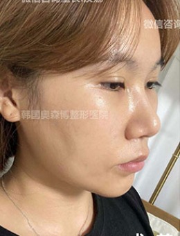 韩国德丽珍鼻修复整形前后对比图