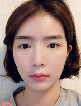 韩国TS整形眼修复+鼻失败修复前后对比照片