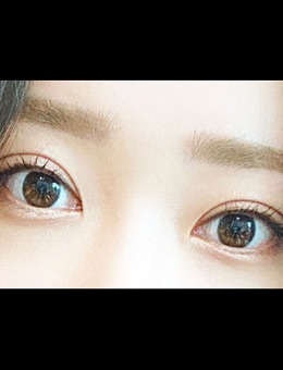 -韩国ICON埋线修复双眼皮手术照片