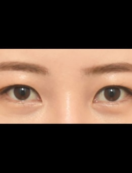韩国ICON双眼皮+去眼内脂肪对比照片