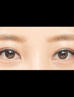 -韩国ICON双眼皮+去眼内脂肪对比照片