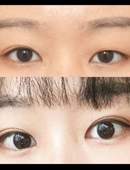 眼睛一单一双大小眼“三重埋线修复术”案例分享，由韩国icon整形主刀！_术后