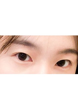 -韩国yellow双眼皮自然流畅型+上眼睑手术对比图