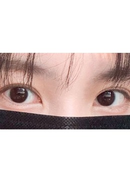 -韩国yellow双眼皮自然流畅型+上眼睑手术对比图