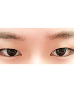 -韩国Yellow整形双眼皮手术前后对比照片