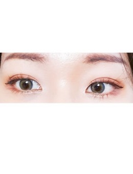 -韩国yellow整形双眼皮手术案例前后对比图