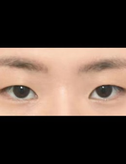 -韩国icon三重埋线+开前眼角手术对比图
