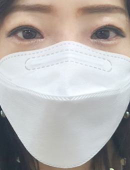 韩国dr朵非切开眼肌矫正手术对比照_术后