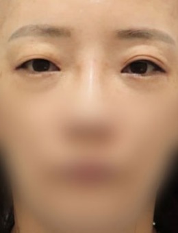 韩国dr朵非切开眼肌矫正手术对比照