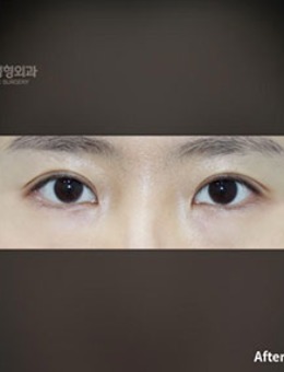 -韩国普拉美斯自然流畅双眼皮手术案例
