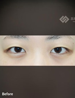 韩国普拉美斯自然风双眼皮手术对比照_术前