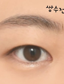 韩国icon整形单眼皮改双眼皮手术对比照_术前