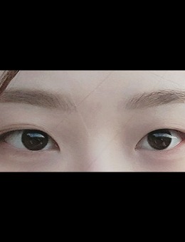 -韩国icon整形三重埋线+开眼角手术案例