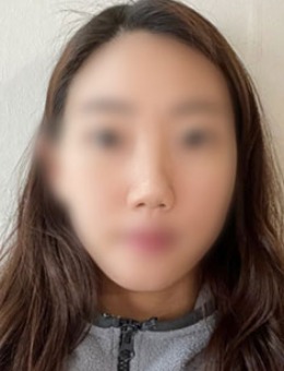 -韩国dr朵整形硅胶隆鼻+鼻中隔延长手术对比照