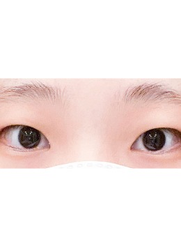 -韩国yellow自然流畅双眼皮+去眼内脂肪手术案例