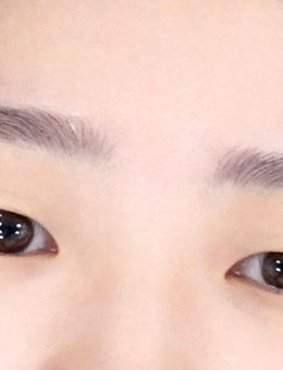 -韩国yellow自然流畅双眼皮+开眼角手术对比照