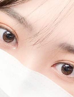 -韩国yellow自然流畅双眼皮+开眼角手术对比照