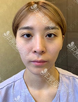 -韩国TS全脸综合整形打造：脸上动刀超过六个项目！