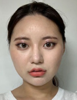 韩国dr朵整形面部轮廓手术前后对比日记_术前